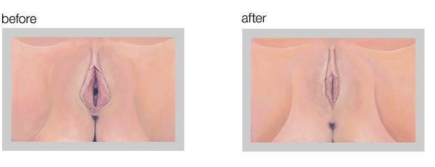 Vaginoplasty Cosmetic Gynecology 
